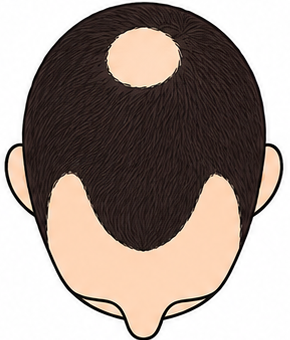 Stage 3